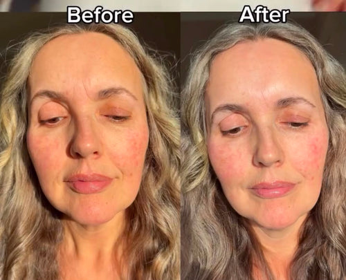 LED Facial Mask in use